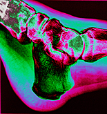 Health, x-ray, x-rays, xray, xrays, foot, feet, bone, bones, human bone, human bones, ankle, ankles, AB67,