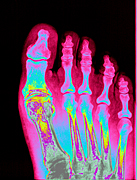 Health, x-ray, x-rays, xray, xrays, foot, feet, bone, bones, human bone, human bones, toe, toes, AB67,