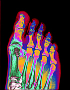 Health, x-ray, x-rays, xray, xrays, foot, feet, bone, bones, human bone, human bones, toe, toes, AB67,