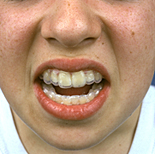 People, child, children, puberty, Health, Dentistry, teeth, dental, people, child, children, puberty, child, children, teenager, teenagers, teenage girl, teenage girls, adolescent, adolescents, dental, brace, braces, mouth, mouths, ab67,