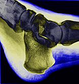 Health, x-ray, x-rays, xray, xrays, foot, feet, bone, bones, human bone, human bones, ankle, ankles, AB67,