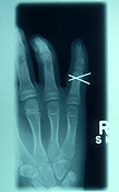 Health, x-ray, x-rays, xray, xrays, hand, hands, finger, fingers, broken, broken finger, broken fingers, child, children, bone, bones, human bone, human bones, knuckle, knuckles.