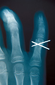 Health, x-ray, x-rays, xray, xrays, hand, hands, finger, fingers, broken, broken finger, broken fingers, child, children, bone, bones, human bone, human bones, knuckle, knuckles.