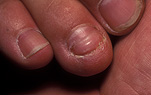Finger, fingers, nail, nails, fingernail, fingernails, finger nail, finger nails, damaged nail, damaged nails, damaged fingernail, damaged fingernails, damaged finger nail, damaged finger nails, chewed fingernail, chewed fingernails, chewed nail, chewed nails, chewed finger nail, chewed finger nails, bitten nail, bitten nails, bitten finger nail, bitten finger nails, bitten fingernail, bitten fingernails, habit, habits, bad habit, bad habits, nailbiting, nail biting.