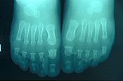 Health, x-ray, x-rays, xray, xrays, foot, feet, bone, bones, human bone, human bones, toe, toes.